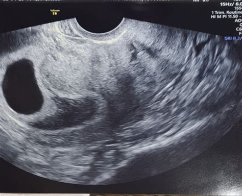I was dated a week behind what i thought i was and i had a yolk sac but no fetus at 63 and went back 10 days later and a baby was there and heart beating away. . Empty sac at 8 weeks success stories ivf